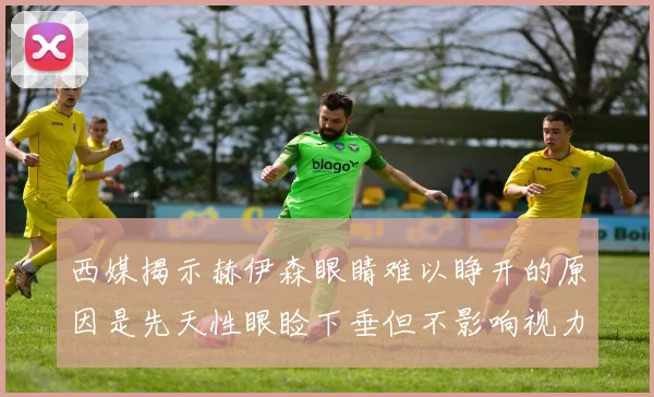 西媒揭示赫伊森眼睛难以睁开的原因是先天性眼睑下垂但不影响视力